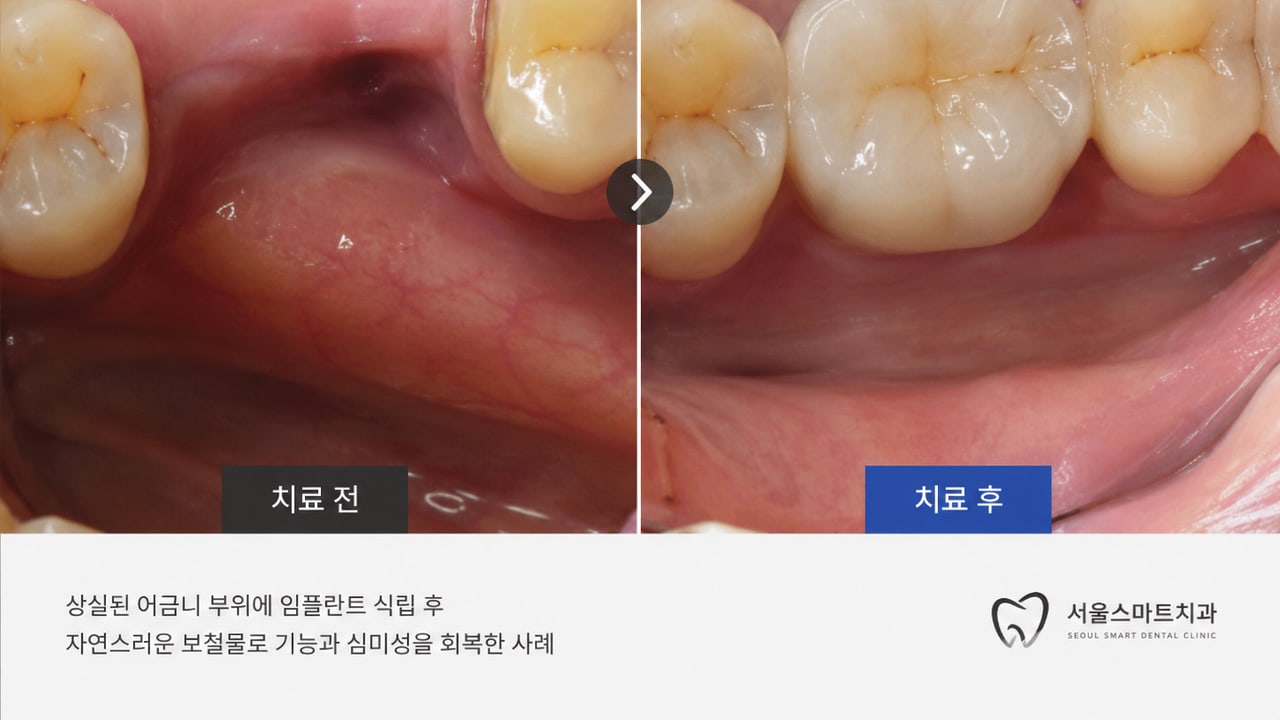 천안 임플란트 상담 상담 전 확인 사진